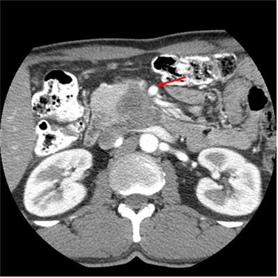 Intraoperative Radiation “Boost” to the Surgical Resection Bed following Pancreaticoduodenectomy for a Borderline Resectable Pancreatic Carcinoma: A Case Report